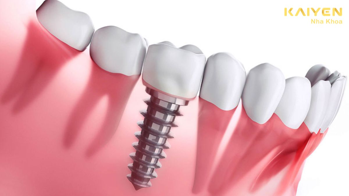 lưu ý sau khi trồng răng Implant