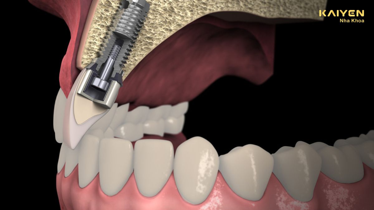 nâng xoang trong cấy ghép implant