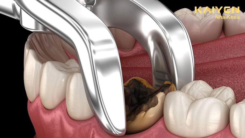 Sau khi nhổ răng bao lâu thì trồng Implant 