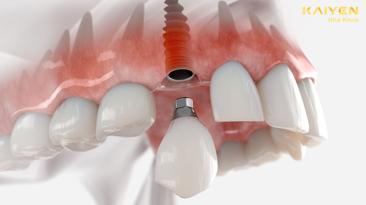 nhược điểm của trồng răng implant