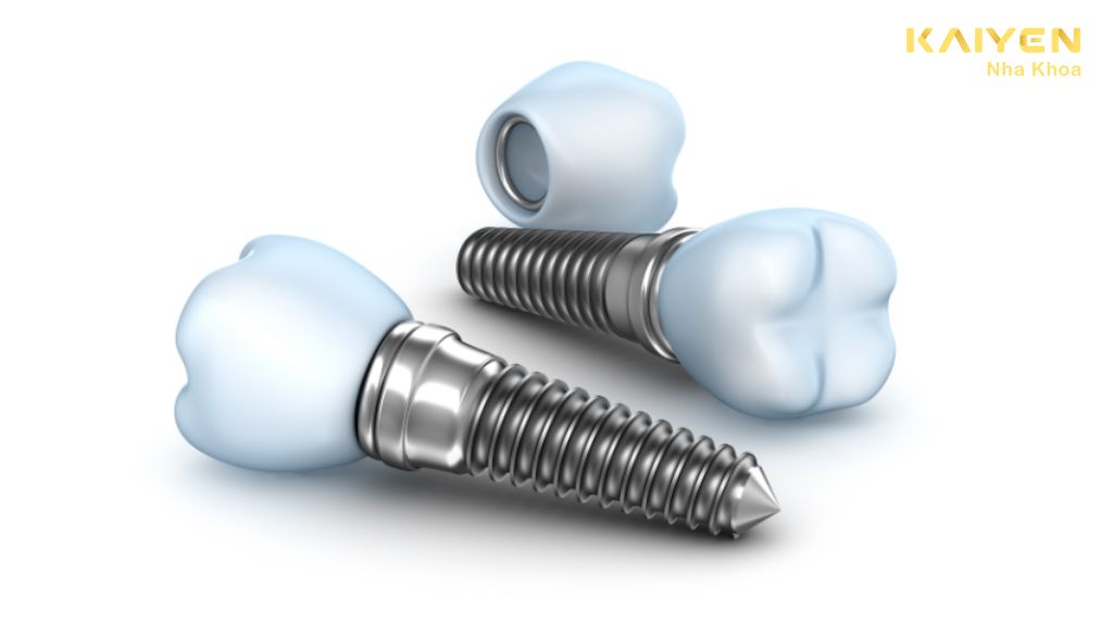  Trồng răng Implant mất bao lâu