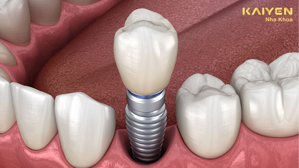 Làm răng Implant có tốt không