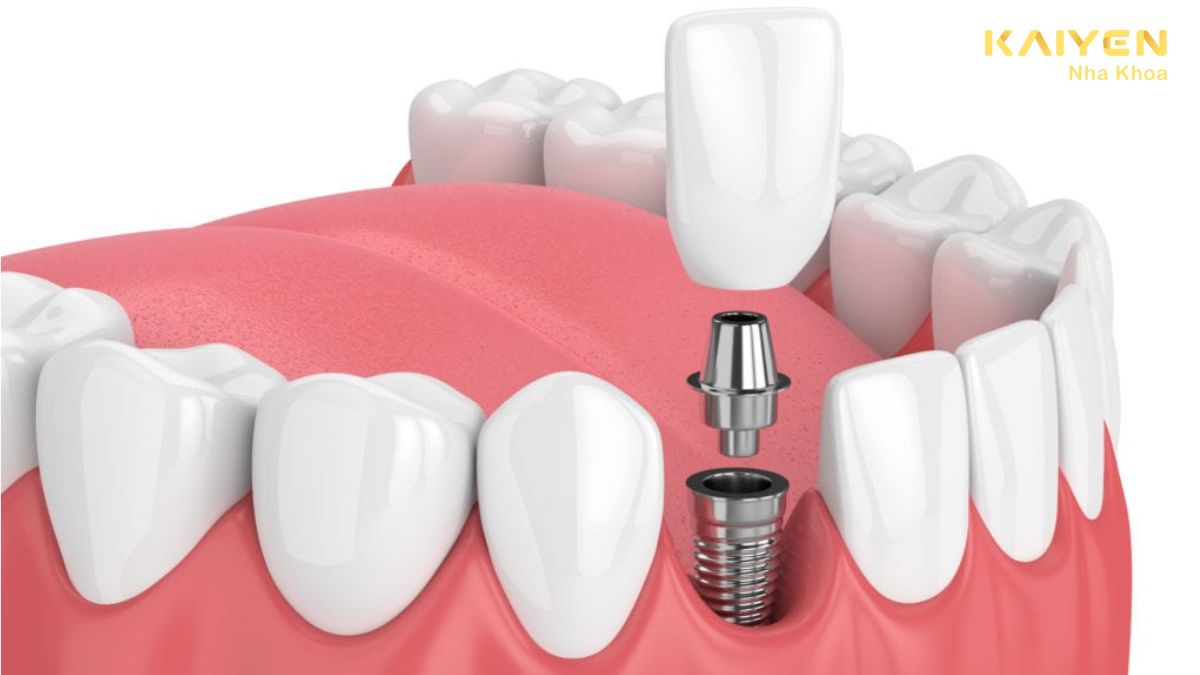 sau khi nhổ răng bao lâu thì trồng Implant