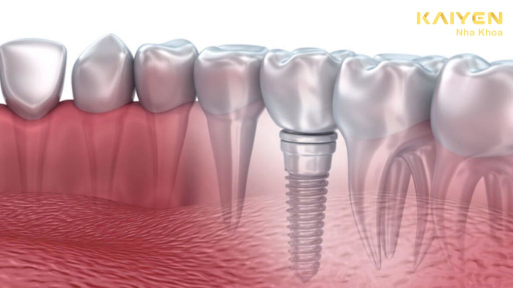 Trồng răng Implant loại nào tốt 