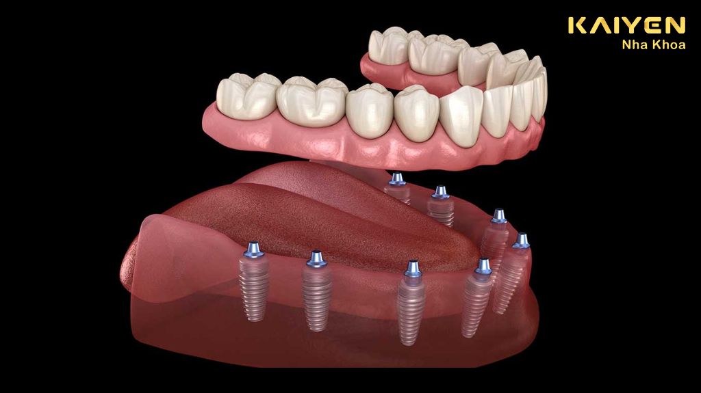 Trồng răng Implant có bền không