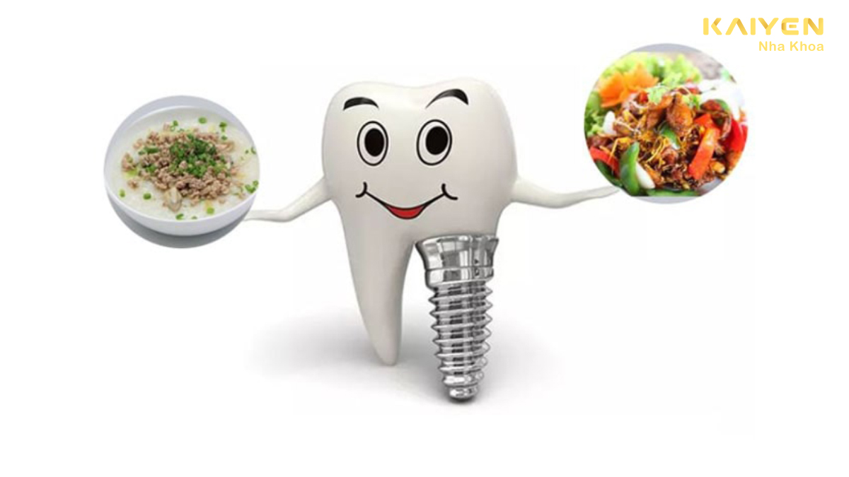 Trồng răng implant bao lâu thì ăn được