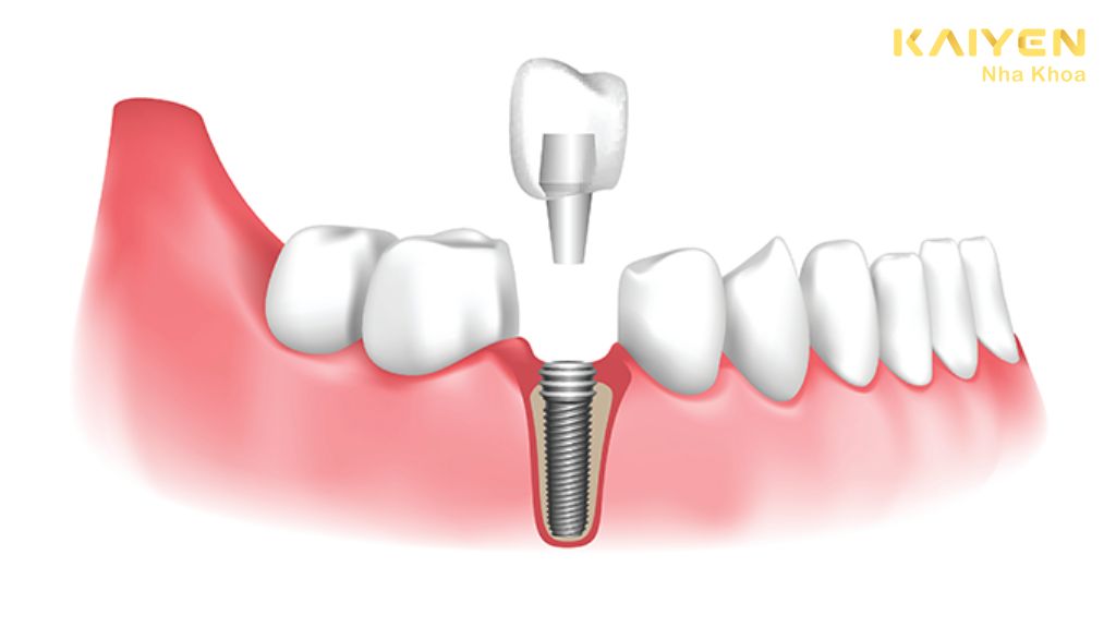Trồng răng Implant bao lâu thì lành?