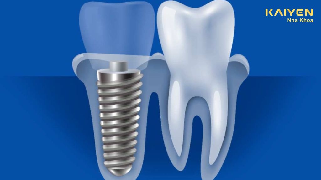 Trồng răng Implant có bị hôi miệng không