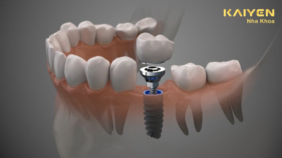 Trồng răng Implant có bị hôi miệng không