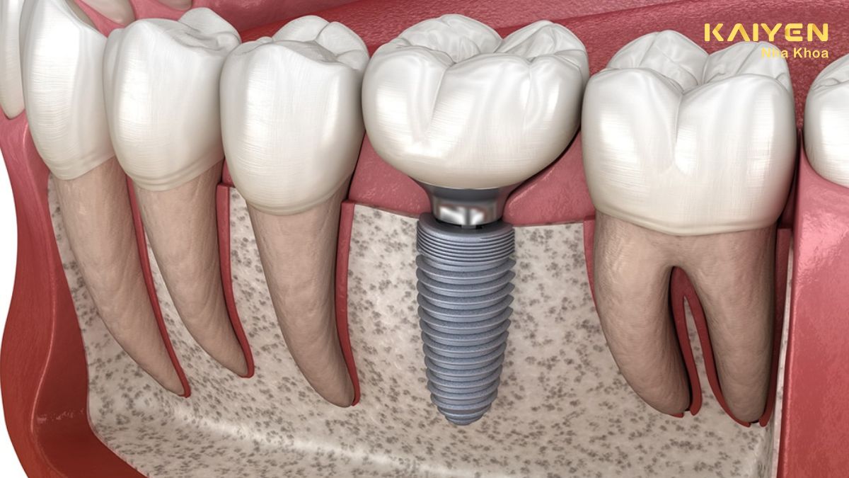 Trồng răng Implant có nguy hiểm không?