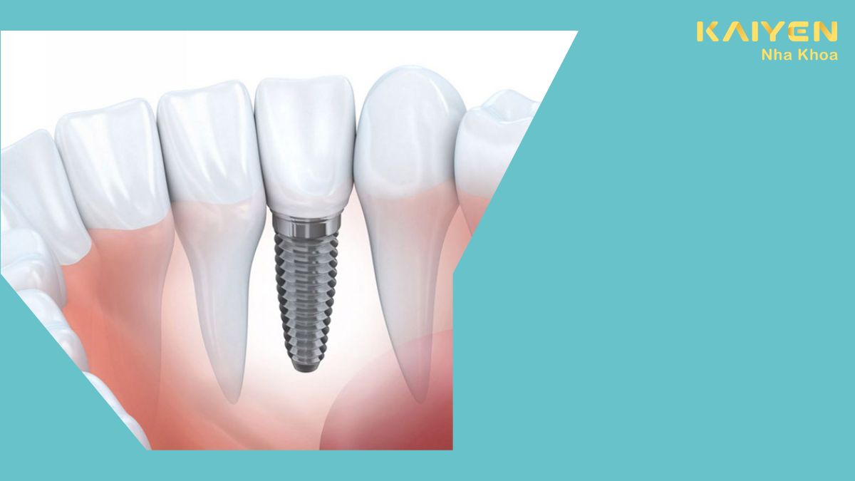 Làm răng Implant có tốt không