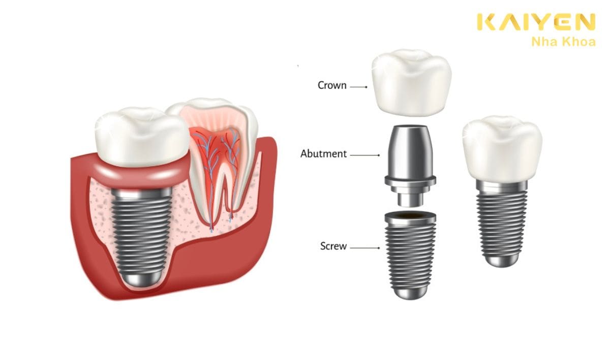 trồng răng implant được bao lâu