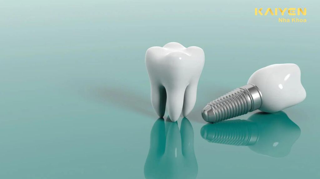 trồng răng implant là gì