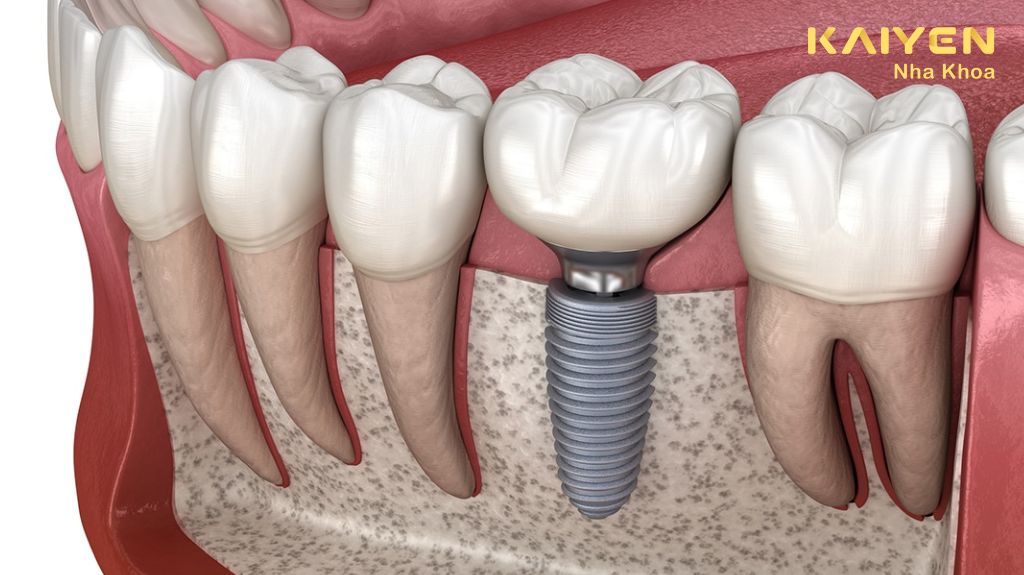 Nhổ răng bao lâu thì trồng Implant được 