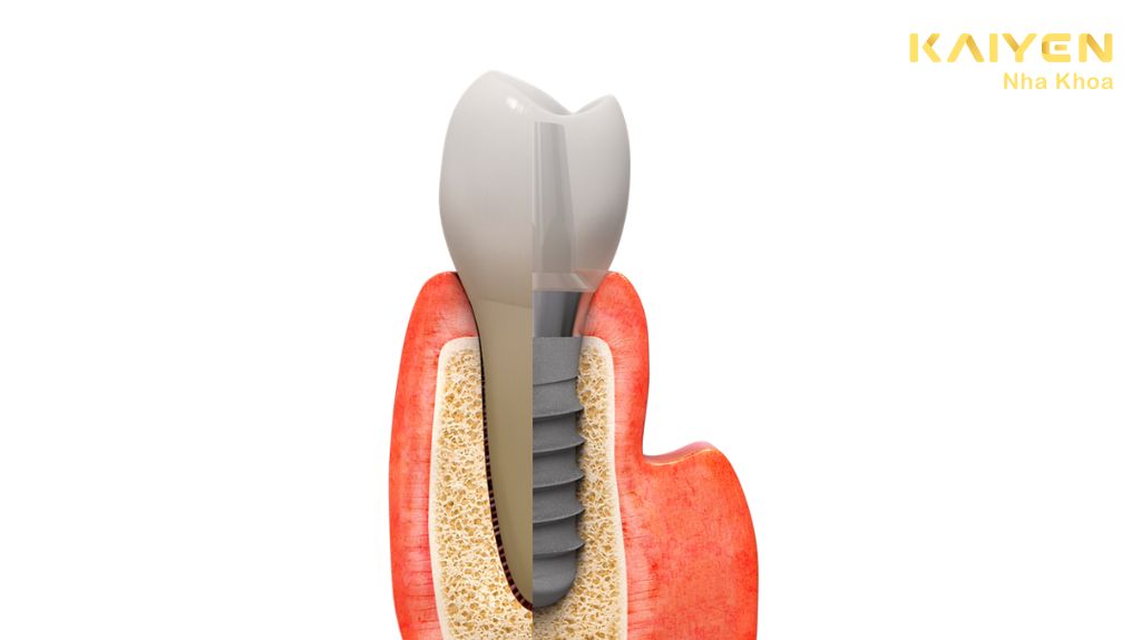 Tuổi thọ trồng răng Implant được bao lâu 