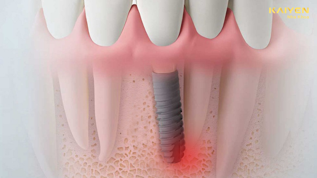Có nên trồng răng implant giá rẻ