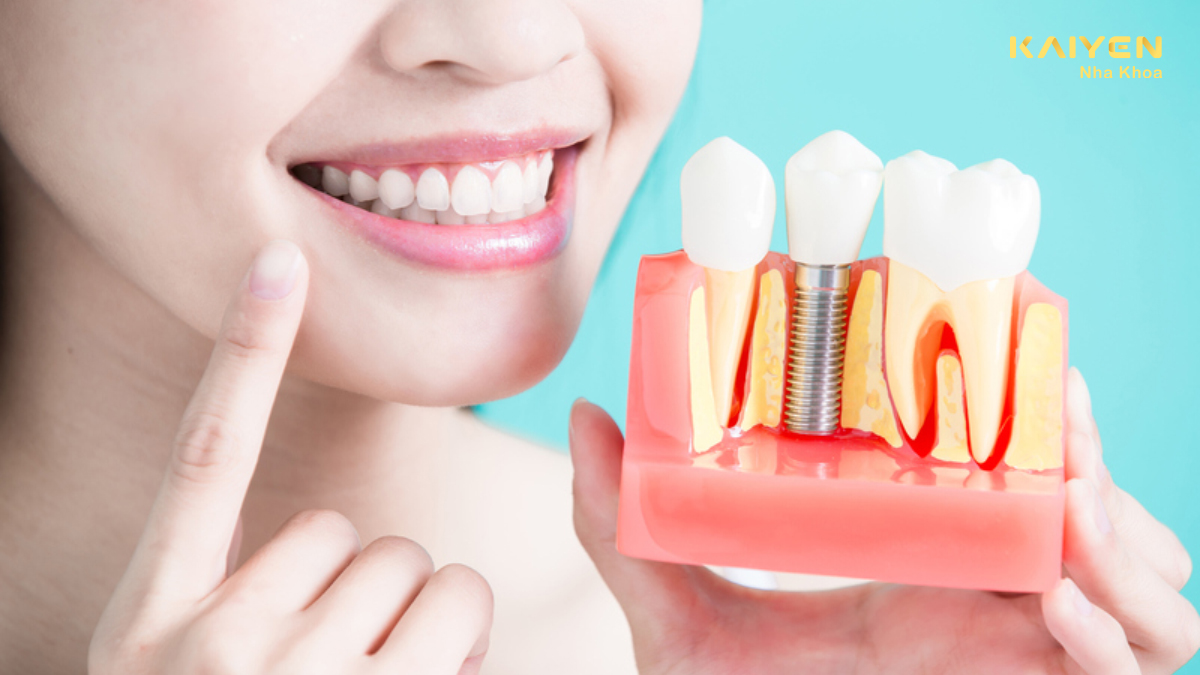 Khi nào nên trồng răng implant
