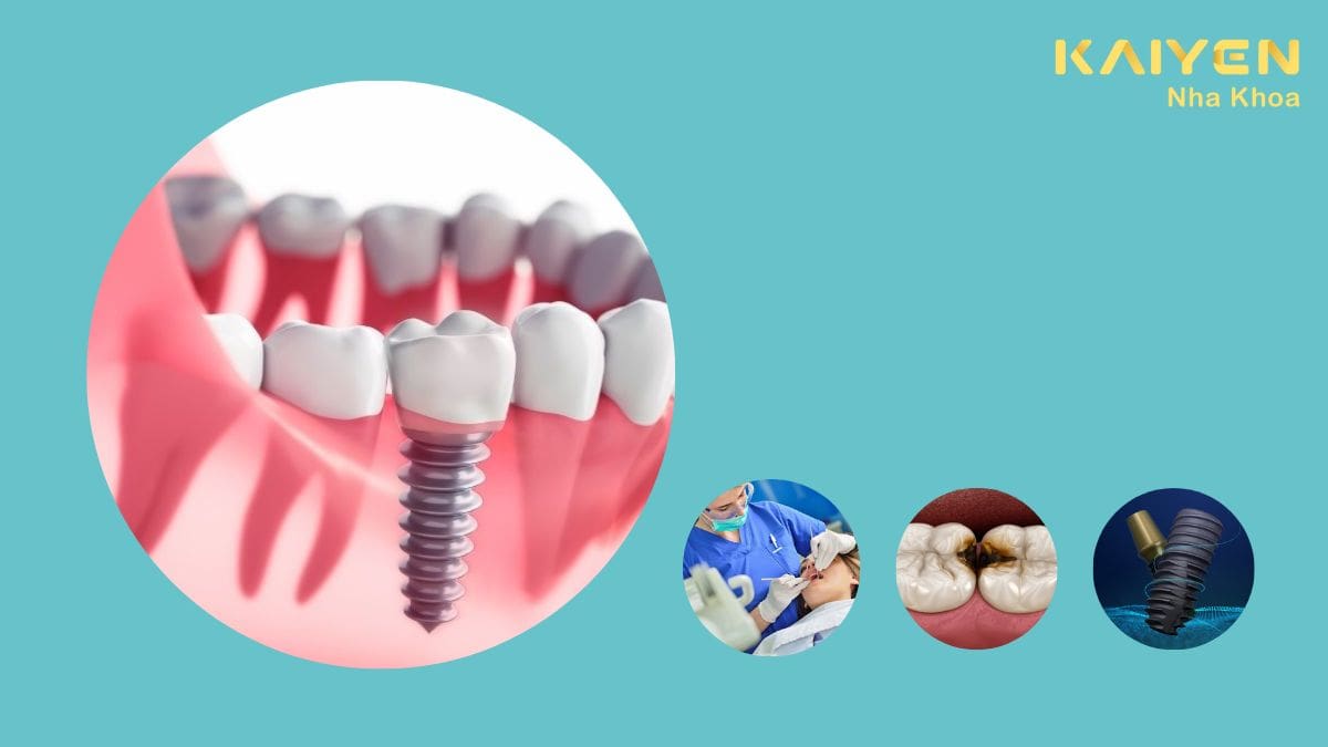 Răng Implant bị đau