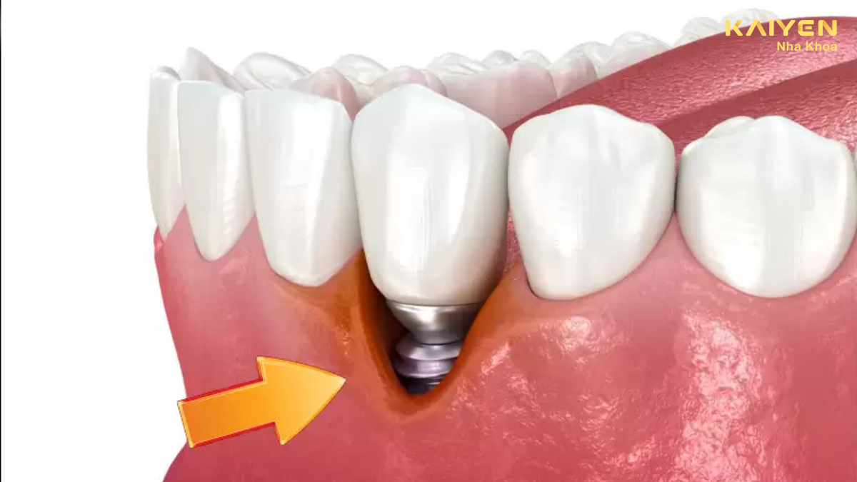 Trồng răng implant bị đào thải