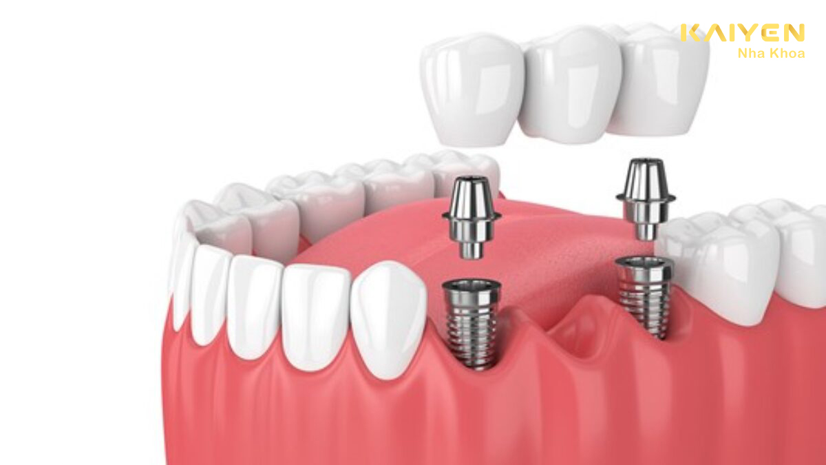 Trồng răng implant có được sử dụng vĩnh viễn không?