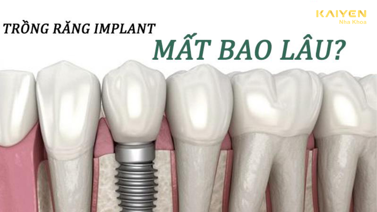 Trồng răng implant mất bao lâu?