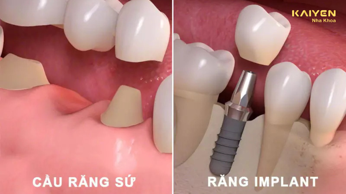 Cầu răng sứ và Implant