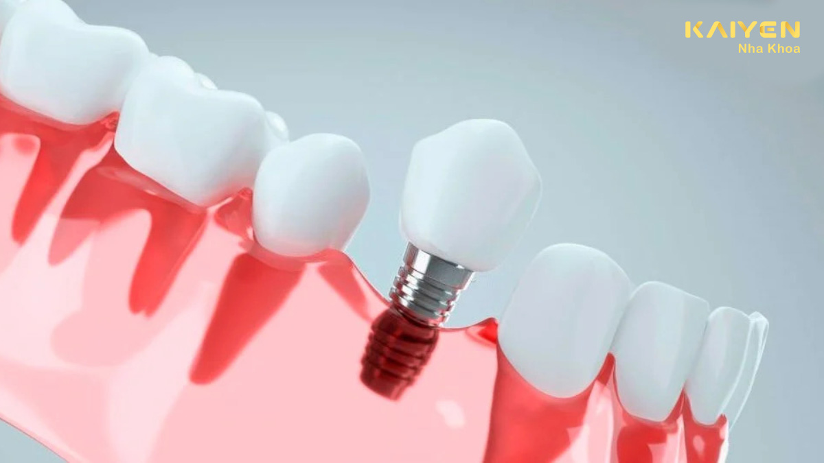 Cắm implant bị lệch