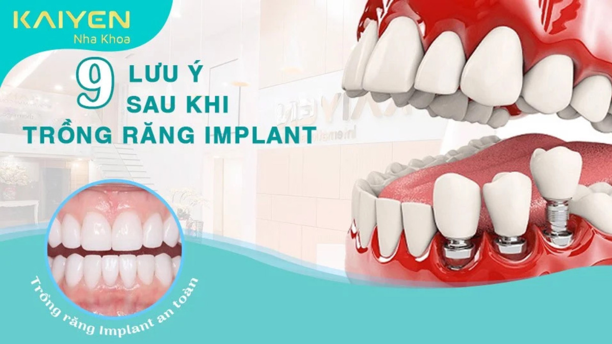 Lưu ý sau khi cắm Implant