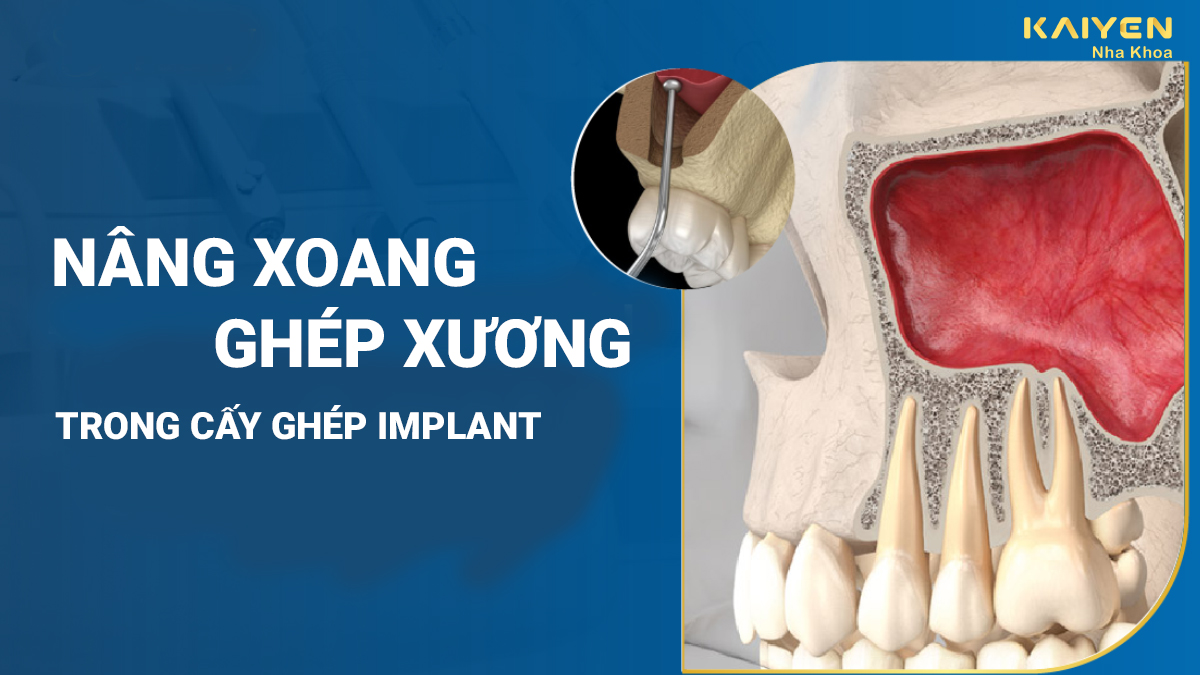 Nâng xoang ghép xương