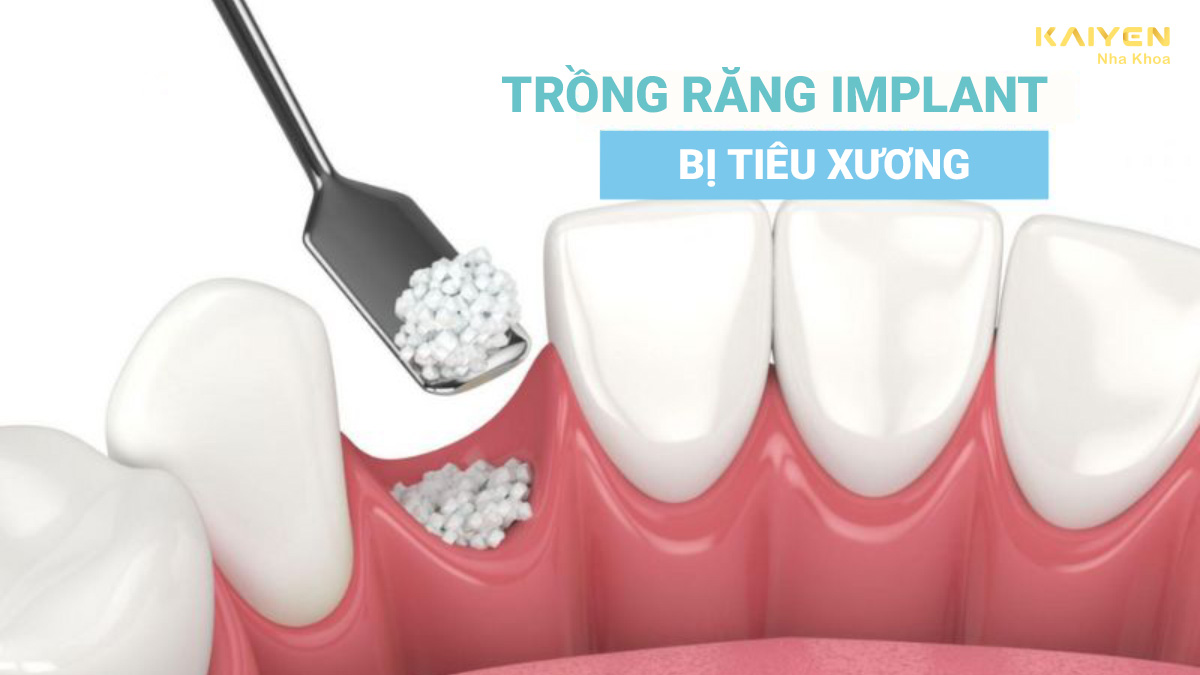 Trồng răng implant bị tiêu xương