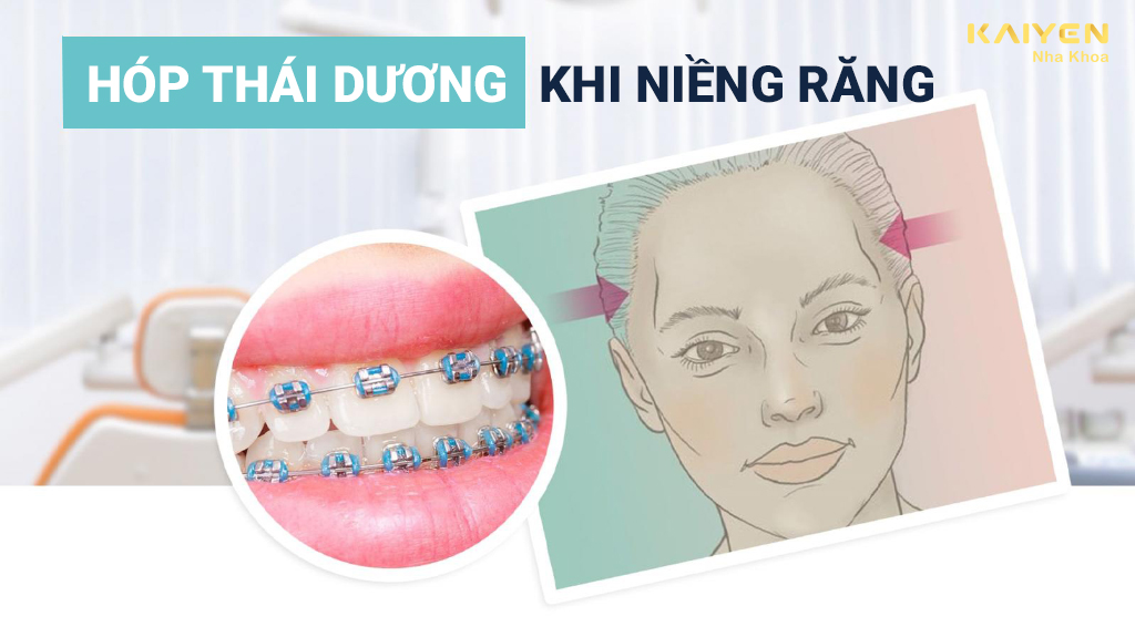 Hóp thái dương khi niềng răng