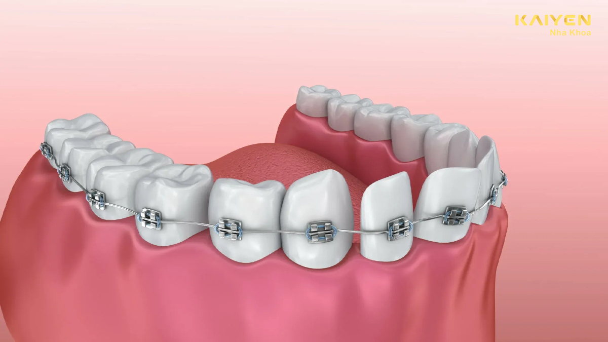 niềng răng hàm dưới