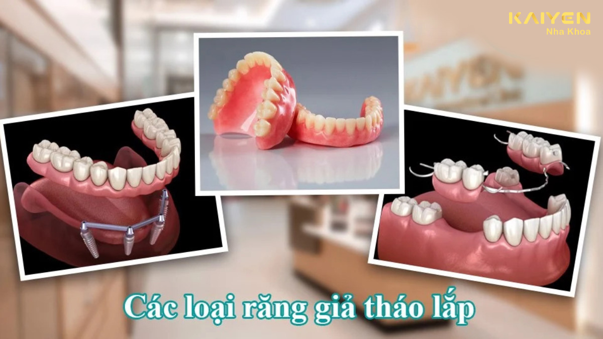 Răng giả tháo lắp loại nào tốt nhất