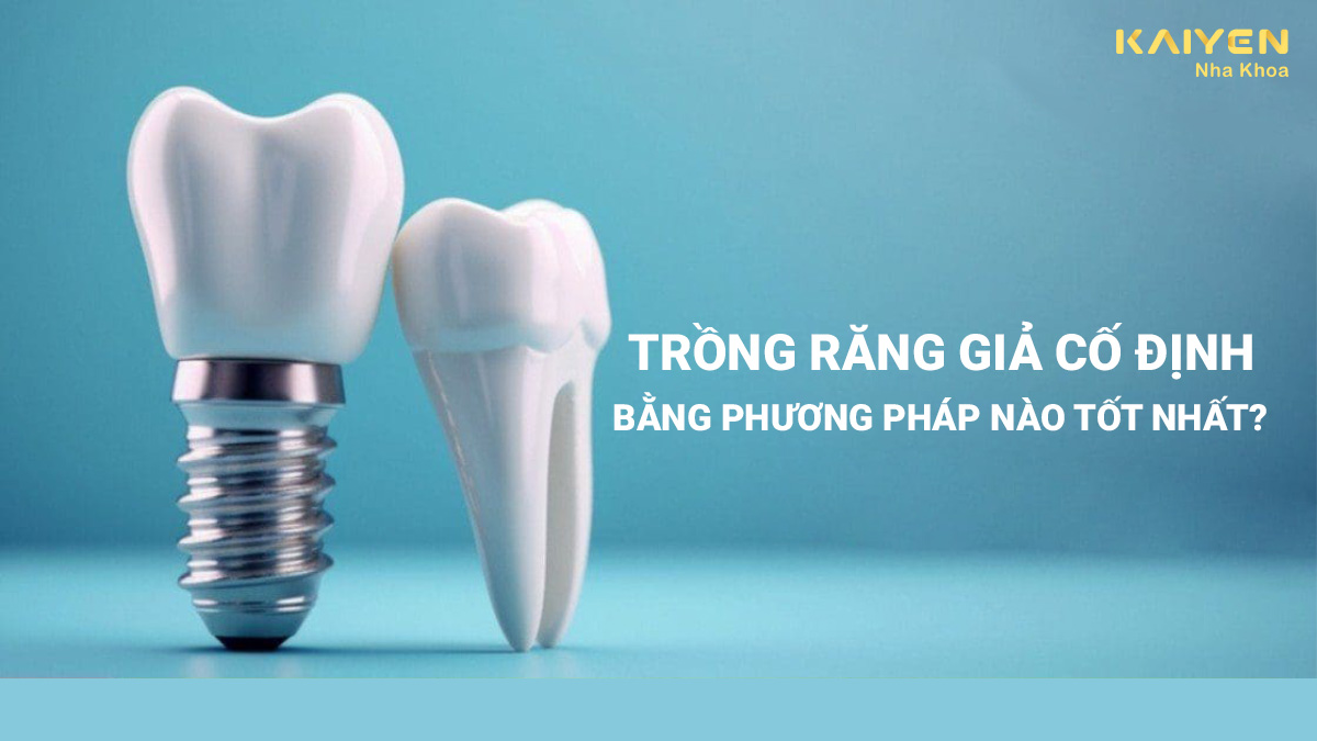 Trồng răng giá cố định