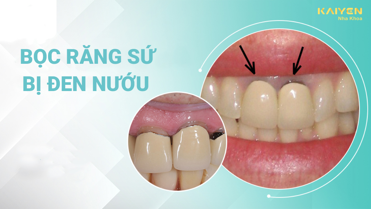 Bọc răng sứ bị đen nướu