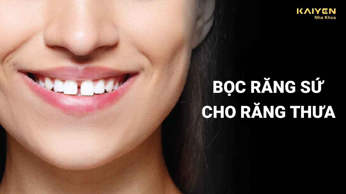 Bọc răng sứ cho răng thưa