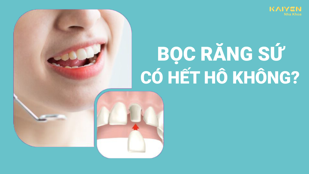 Bọc răng sứ có hết hô không