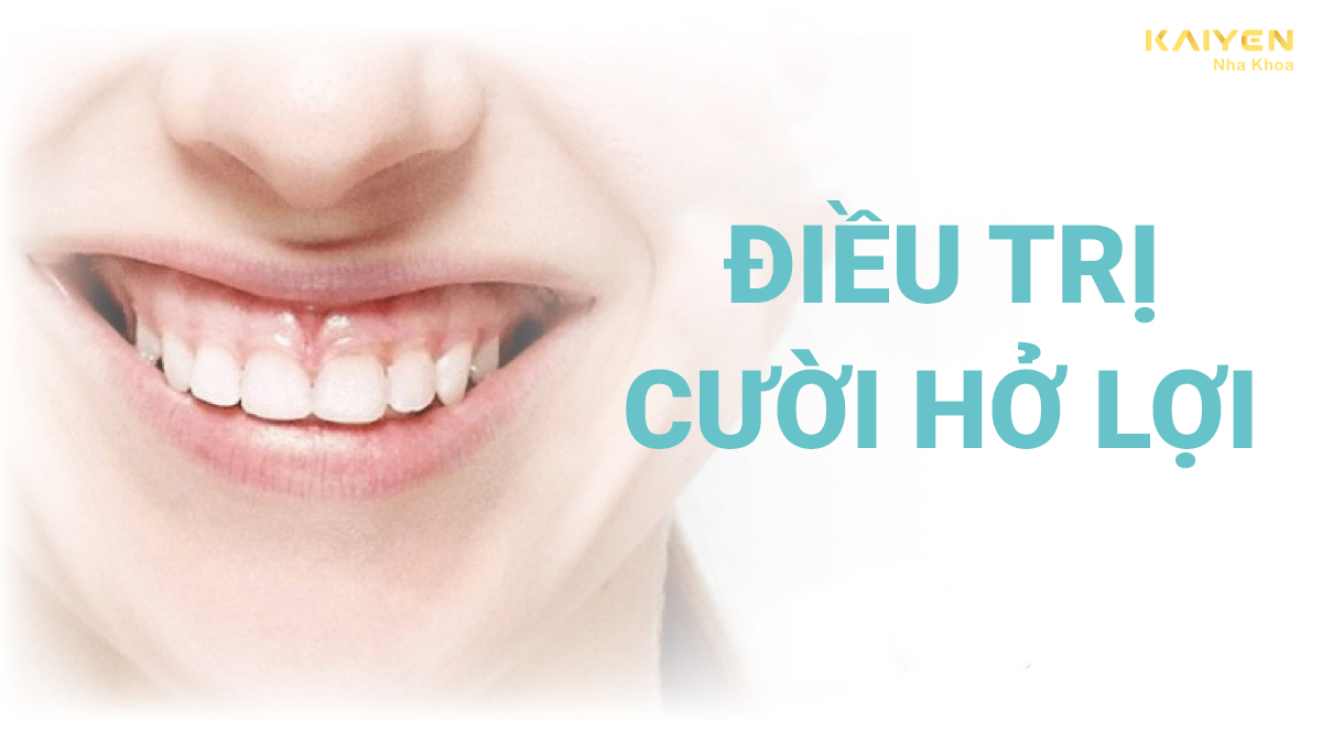 Điều trị cười hở lợi