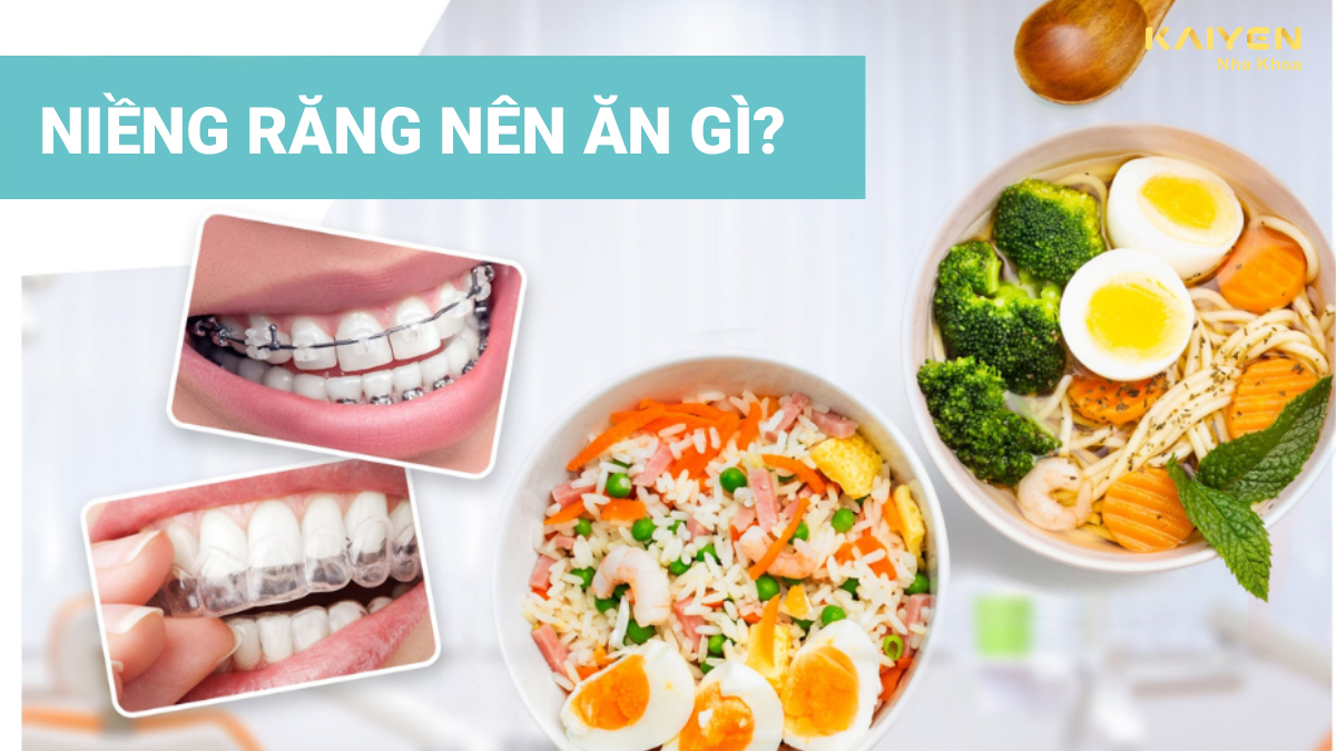 Niềng răng nên ăn gì?