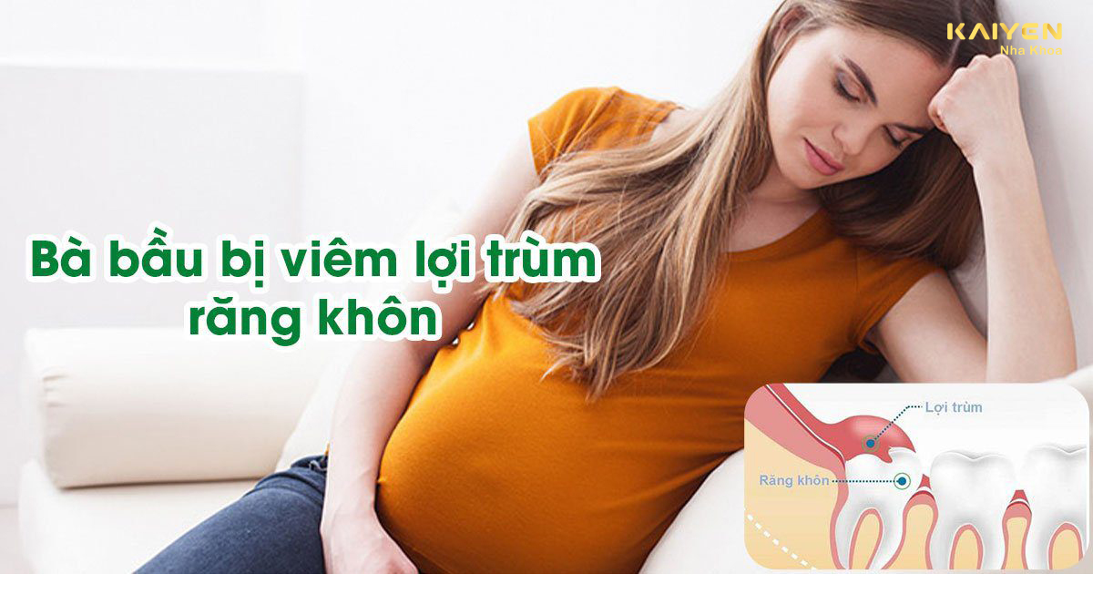 Viêm lợi trùm răng khôn khi mang thai