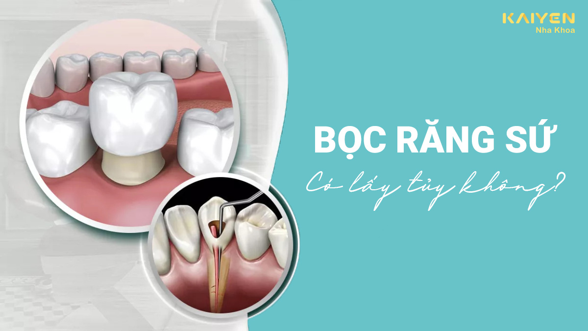 Bọc răng sứ có lấy tủy không?