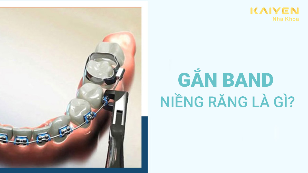 gắn band niềng răng là gì