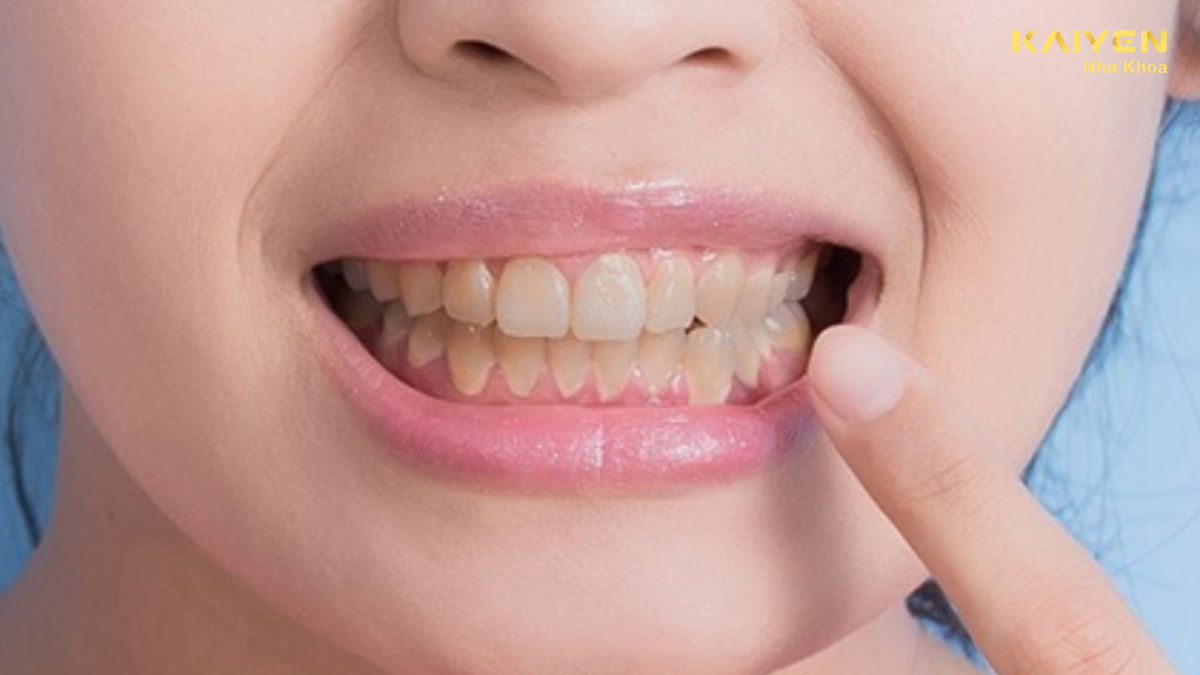 Răng nhiễm tetracycline