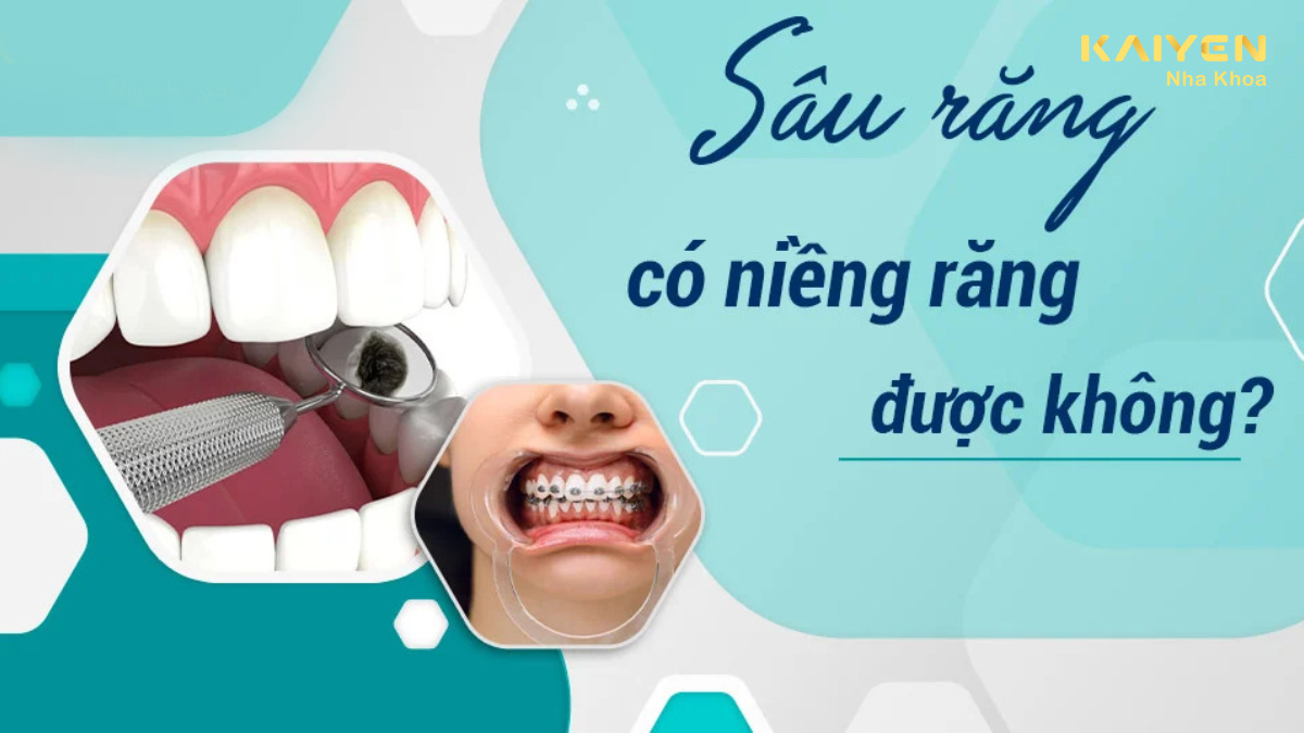 Sâu răng có niềng răng được không