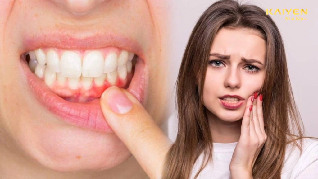 Chảy máu chân răng thường xuyên