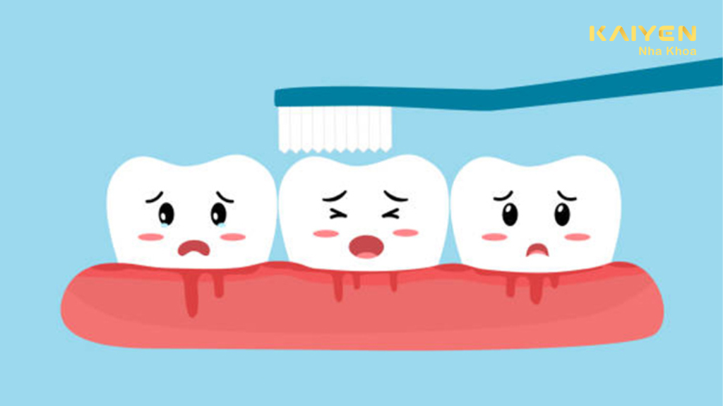 Đánh răng bị chảy máu thường xuyên