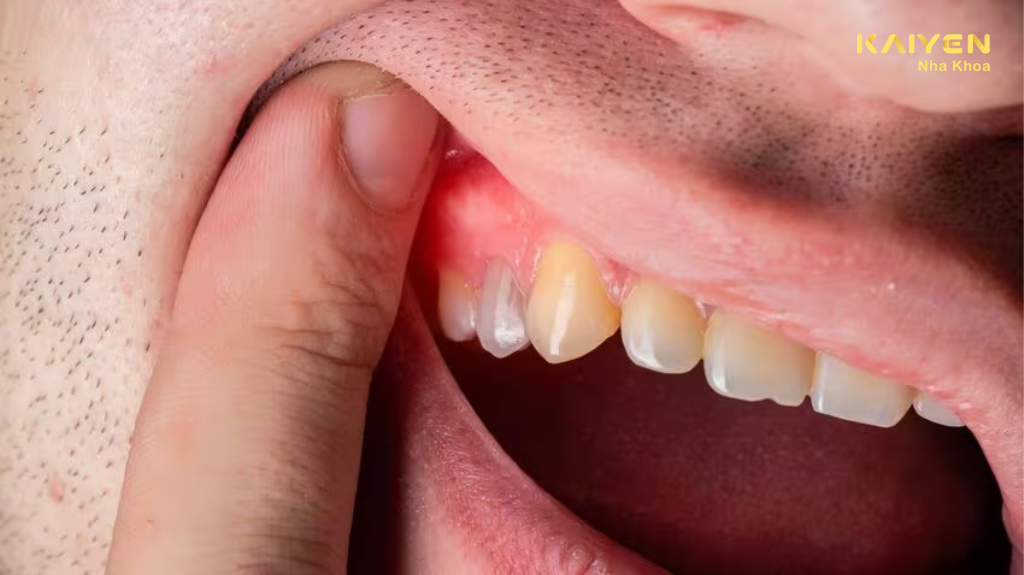 dấu hiệu nhiễm trùng sau khi nhổ răng