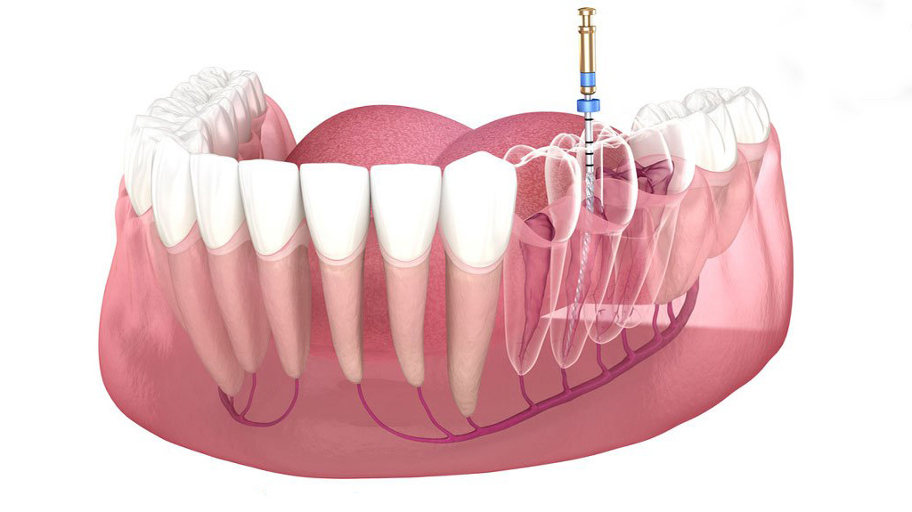 Lấy tủy răng mấy lần mới xong