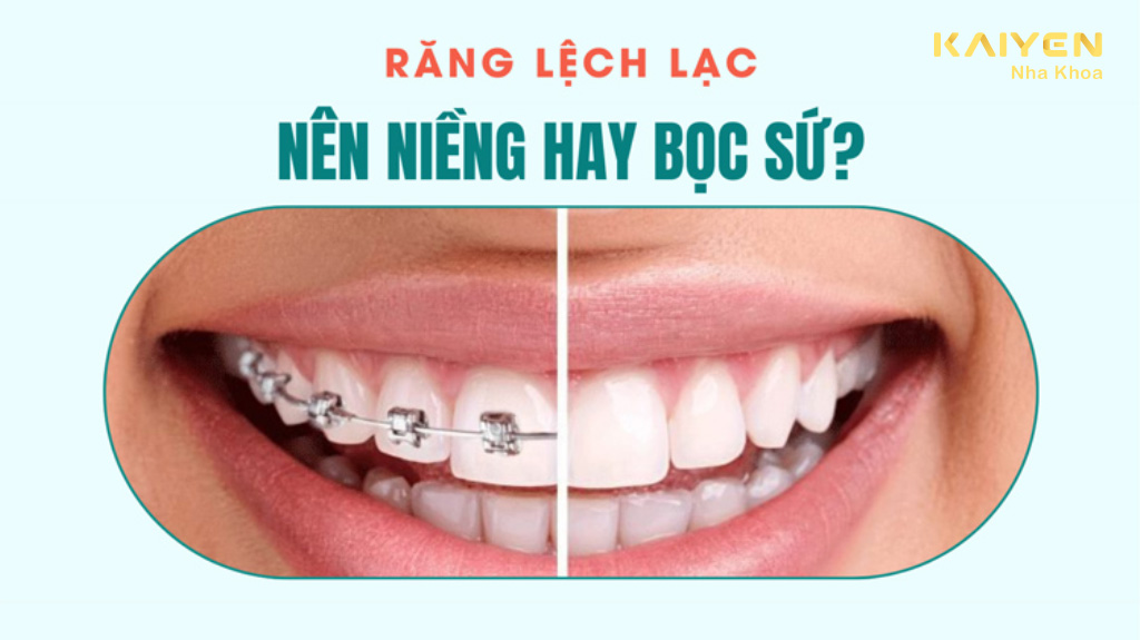 Răng lệch lạc nên niềng răng hay bọc sứ