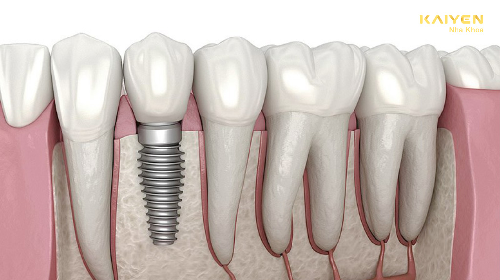 Trồng răng implant có bền không?